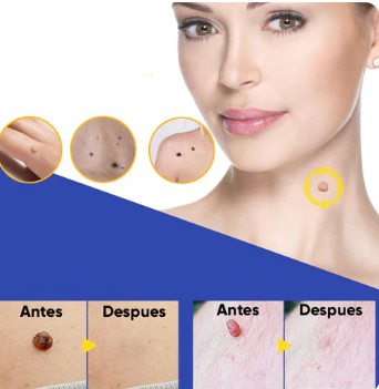 Skin Tag Patches™ Piel libre de verrugas sin dolor